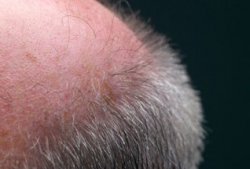 Ученые выяснили причину выпадения волос