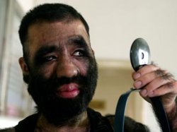 Самый волосатый человек в мире сделает операцию, чтобы стать телезвездой