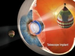 В США разрешили имплантировать глазные телескопы