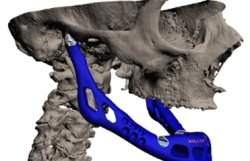 Врачи напечатали на 3D-принтере человеческую челюсть